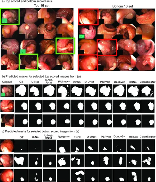 Polyp Detection Using Image Segmentation: A Research Breakthrough in Medical AI
